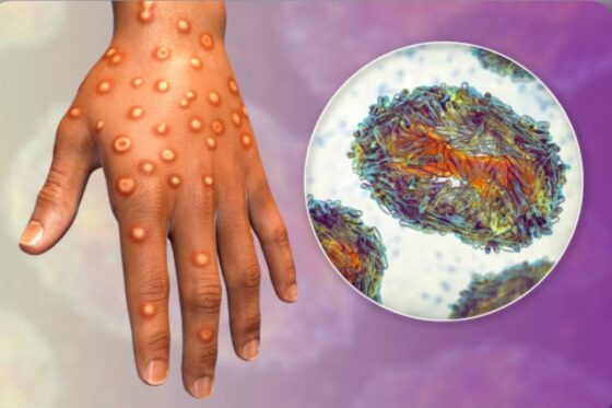 Mpox – Quelle action urgente pour freiner la transmission du virus ?